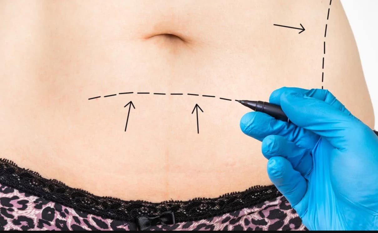 Combo de lipo, mama y abdomen, las cirugías plásticas más demandas