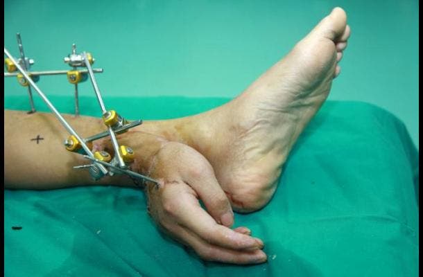 Mano amputada de un chino fue injertada en su pierna durante un mes