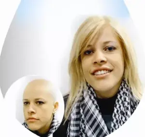 La alopecia se corrige sin el uso de  cirugía