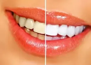 ¿Te gustaría tener unos dientes perfectos? 10 trucos caseros para lograrlo