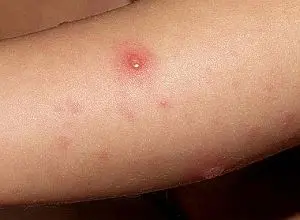 Jesús Feris Iglesias: Niños con varicela deben quedarse en sus casas para evitar contagiar a otros