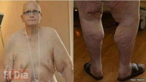 El exhombre más gordo del mundo que se quitó 25 kilos de piel para caminar mejor