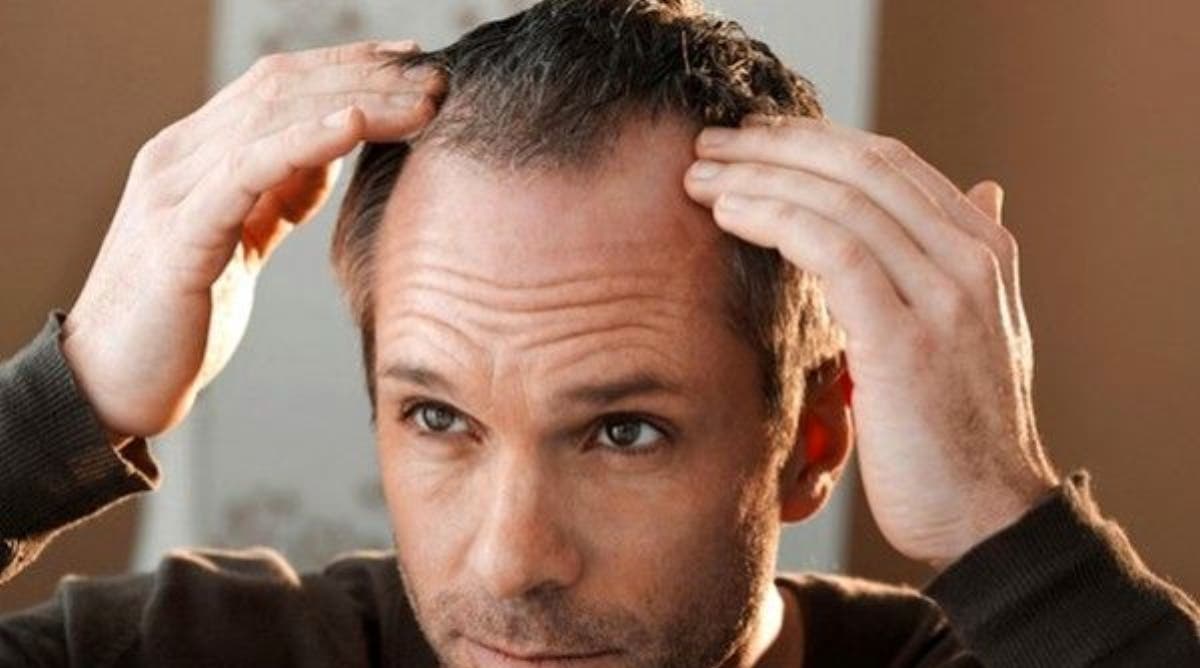 Aquí te decimos como tratar la alopecia de forma natural