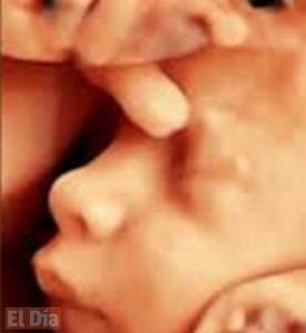 El 3D en sonografía fetal,   es un buen aliado