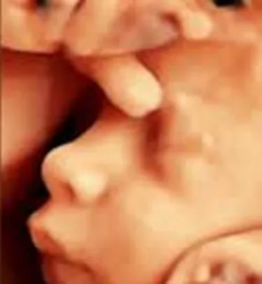  El 3D en sonografía fetal,   es un buen aliado