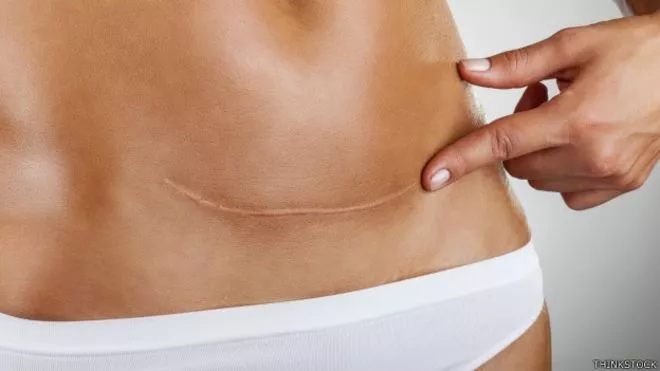 Lo normal sería un 10% o 15% de partos por cesárea, pero en países como Brasil superan el 50%.