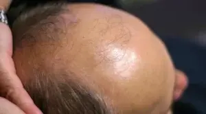 Alopecia androgénica afecta 40%  hombres