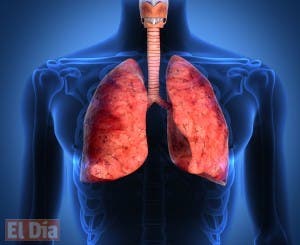 Cuidado con tumor de pulmones y las  disfunciones cerebrales