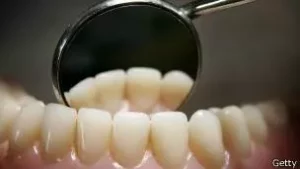 Ningún procedimiento de blanqueo dental es permanente.