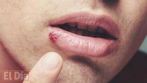 Herpes: La infección que sufren 3.700 millones de personas (y quizás tú)