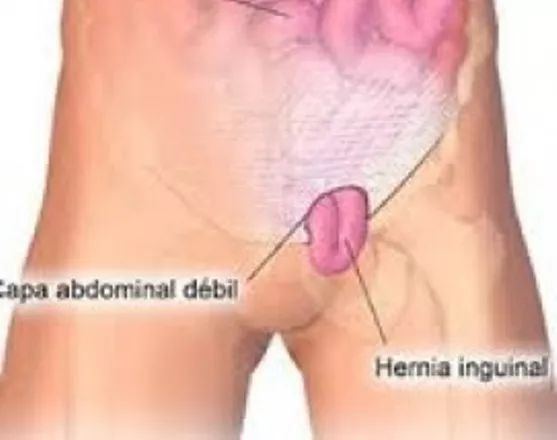 Nuevo método reparar hernia inguinal produce buenos resultados