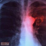 Casi dos mil pacientes con tuberculosis reciben tratamiento en RD
