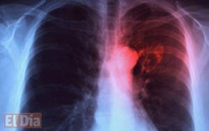 Casi dos mil pacientes con tuberculosis reciben tratamiento en RD