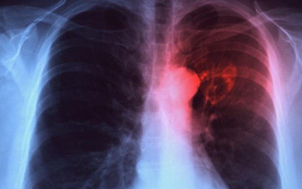 Muertes globales por tuberculosis subieron por primera vez en una década