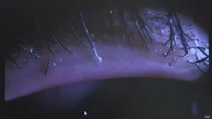 Ojo afectado por colocación de pestañas postizas.