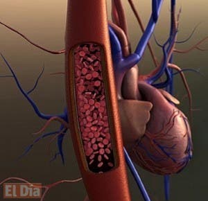 Especialistas hablan método para el control de trombosis y cirrosis