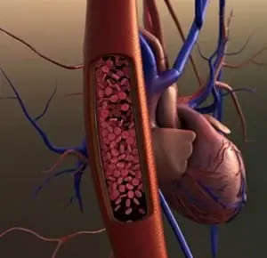 Especialistas hablan método para el control de trombosis y cirrosis