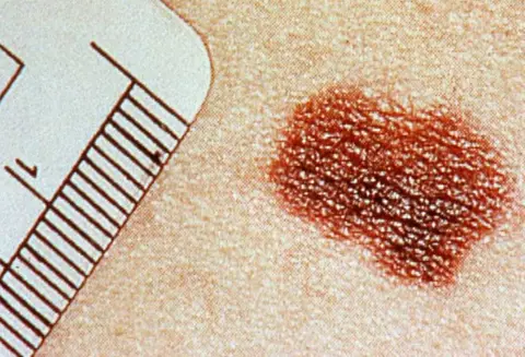 Análisis para detectar  avance del melanoma