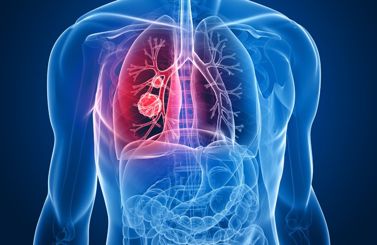 Un análisis de sangre podría mejorar la detección precoz del cáncer de pulmón
