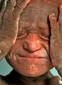 El niño que cambió de piel y  parece estatua de piedra