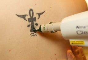 Tecnología láser para eliminar los tatuajes