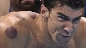 Río 2016: ¿qué son los círculos rojos en la espalda del nadador Michael Phelps?