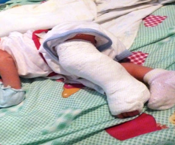 Padres denuncian bebé sufrió fractura al nacer; piden investigación