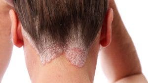 La psoriasis; enfermedad inflamatoria de carácter crónico