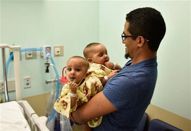 Médicos en NY separan a siamesas dominicanas de 11 meses