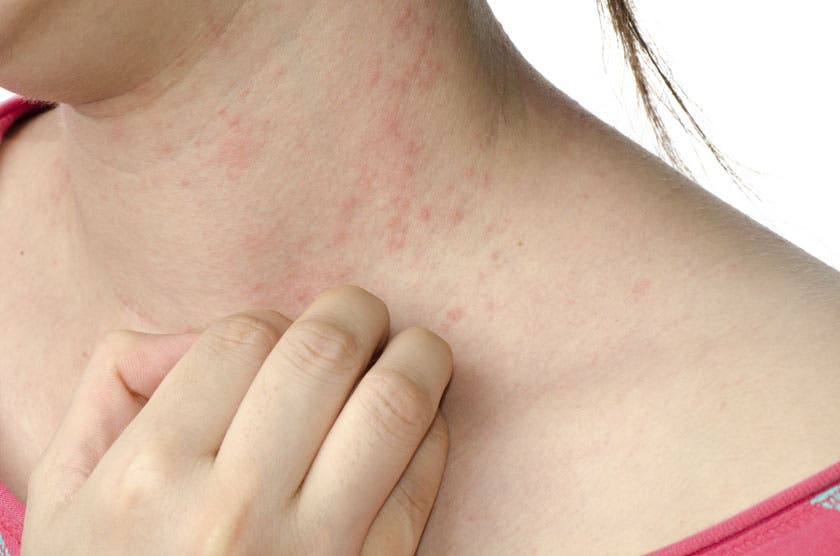 ”Día de la Dermatitis Atópica” se celebra con aumento en su incidencia en el país