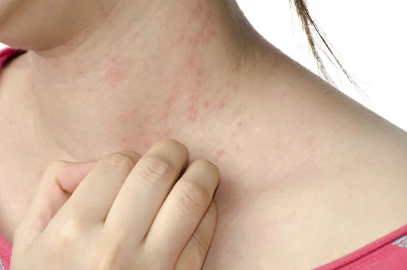 Recomiendan uso de probióticos en diarreas y dermatitis atópicas