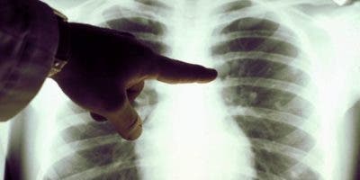 Tomografías y radiografías entran en vía de diagnósticos del Covid-19