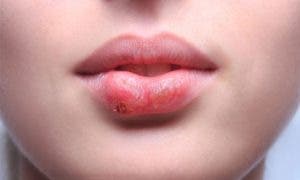 Tratamientos de origen natural para combatir el herpes labial