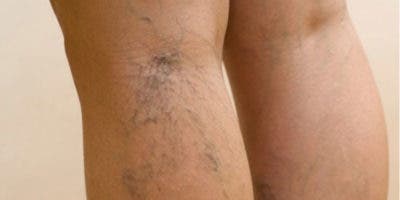 Varices pueden derivar en trombosis de no ser tratadas correctamente