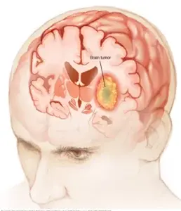 Cómo se originan los tumores en la región selar del cerebro