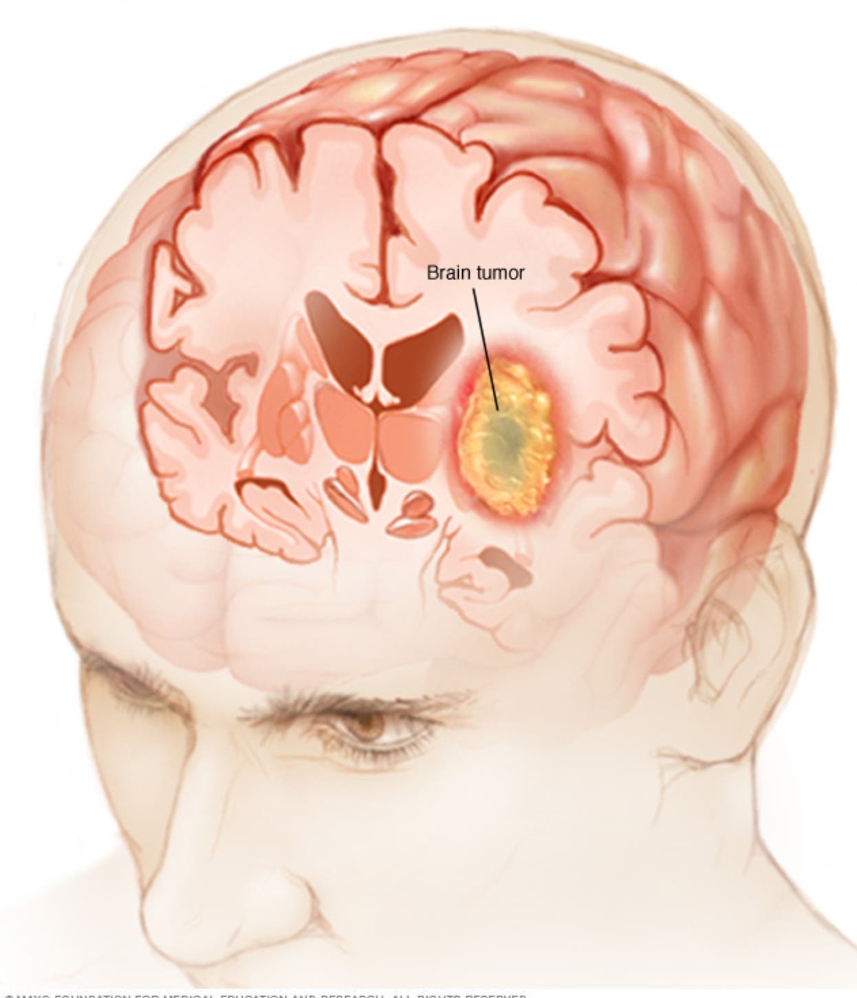 Cómo se originan los tumores en la región selar del cerebro