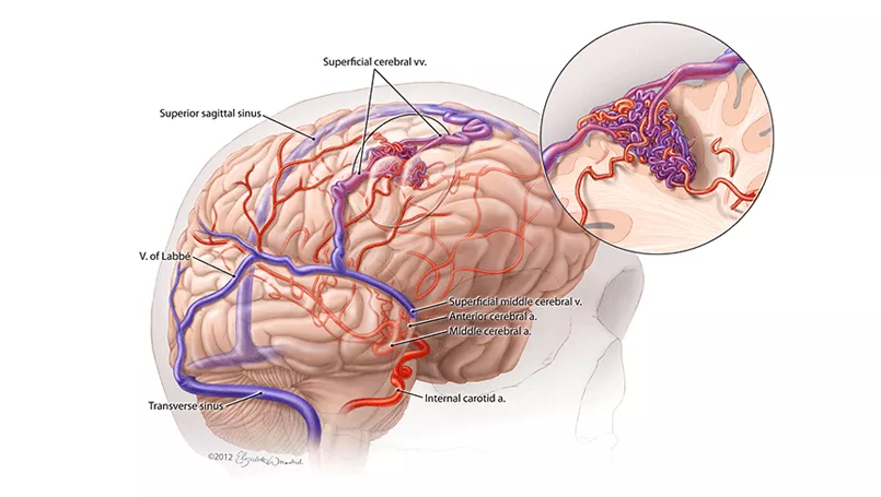 Especialista brasileño advierte sobre riesgo de las malformaciones arteriovenosas