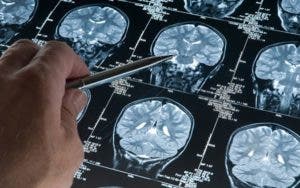 Identificada una molécula con potencial terapéutico contra el Alzheimer