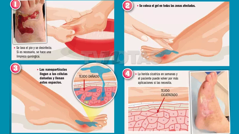 Crean gel para tratar y prevenir el pie diabético