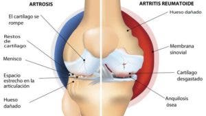 Imagen visual de las partes afectadas de una circulación según las distintas patologías. 