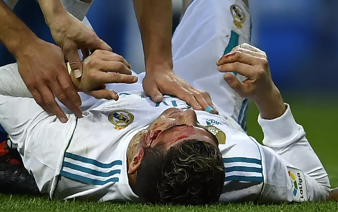 Cristiano Ronaldo sufre una herida  cerca del ojo izquierdo en el partido de Liga