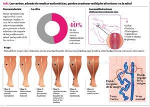 Ejercicios y control de peso ayudan a evitar las varices