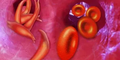 Principales síntomas de la anemia falciforme