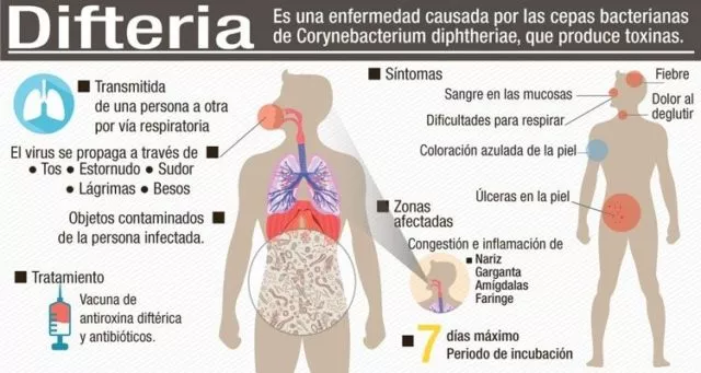 Salud Pública reporta un caso de difteria en niño de cuatro años traído desde Haití