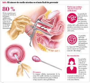 El Papanicolaou es un aliado en la detección del cáncer de cérvix