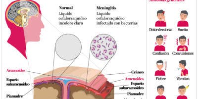 Las secuelas de la meningitis: mal con una alta tasa de  mortalidad