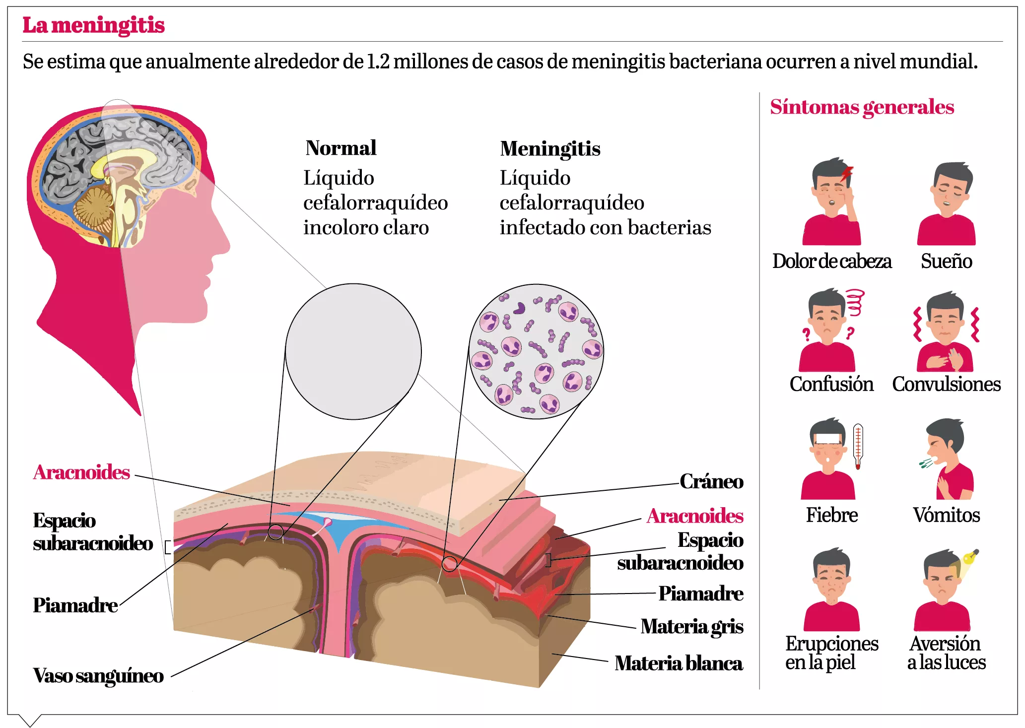 Las secuelas de la meningitis: mal con una alta tasa de  mortalidad