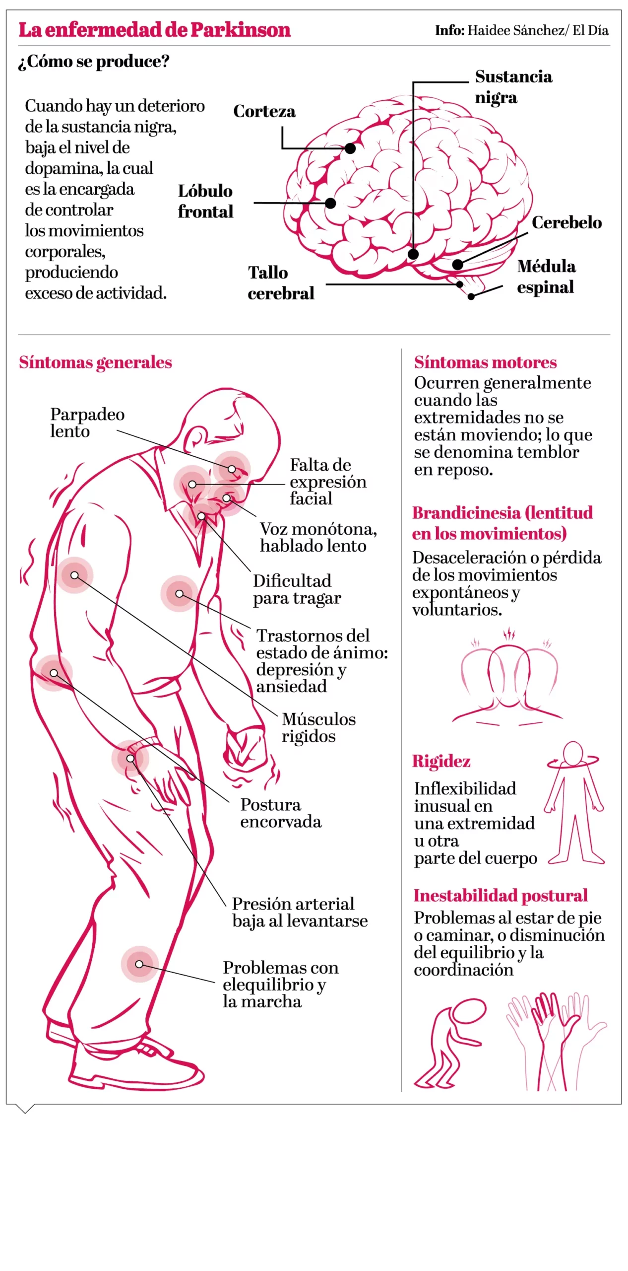 Parkinson, mucho más que un “temblor”