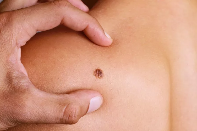 melanoma-2
