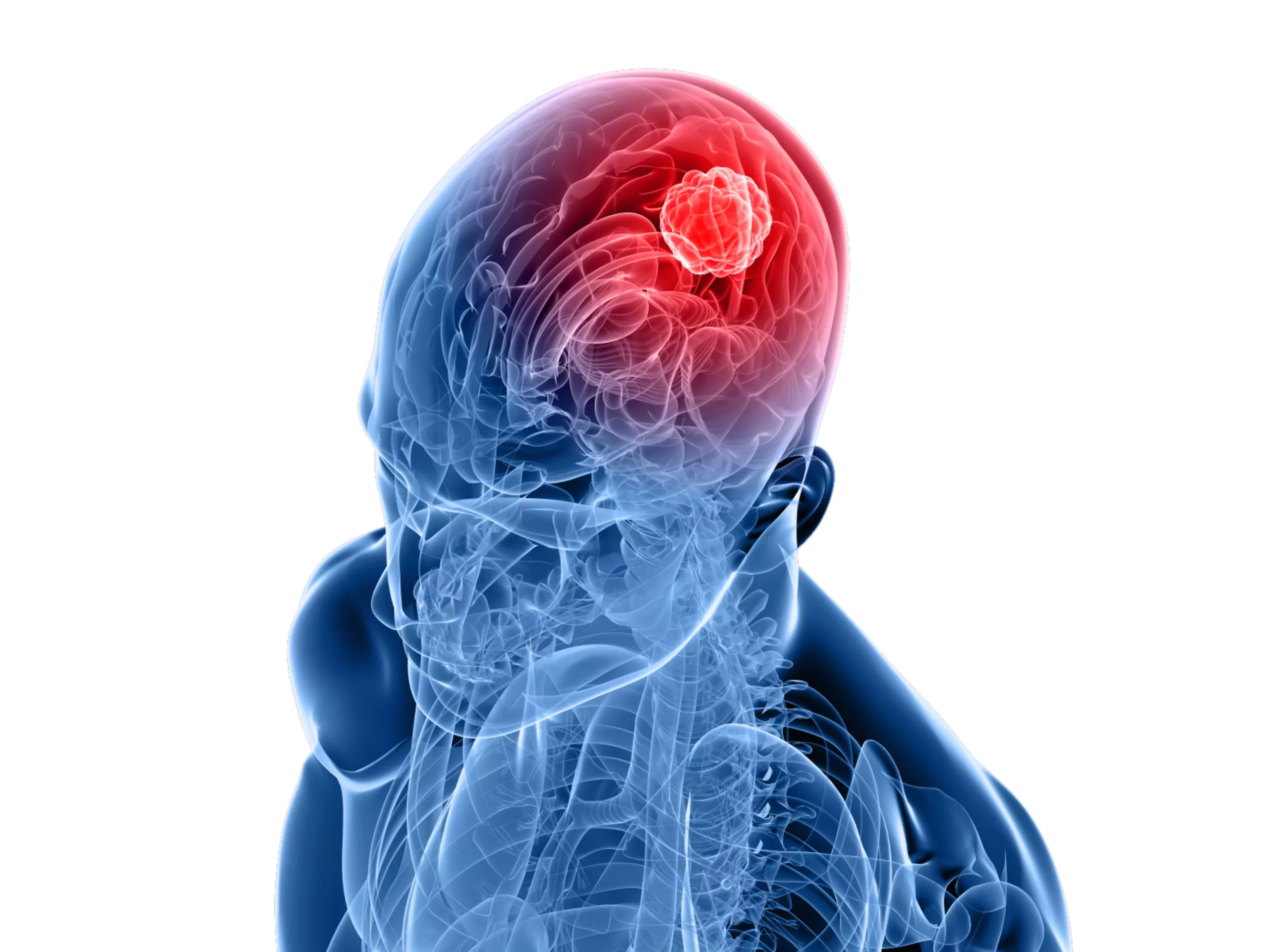 La radiocirugía es la mejor opción en el caso de tumores cerebrales